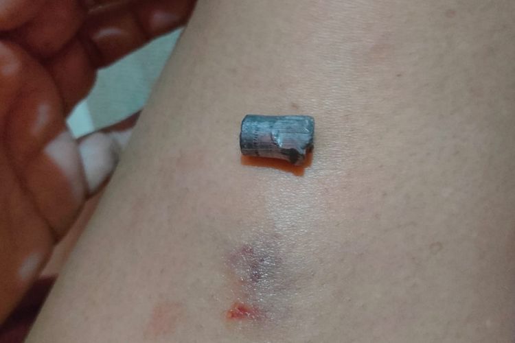 Proyektil peluru yang mengenai kaki warga Surabaya, Senin (23/9/2024).