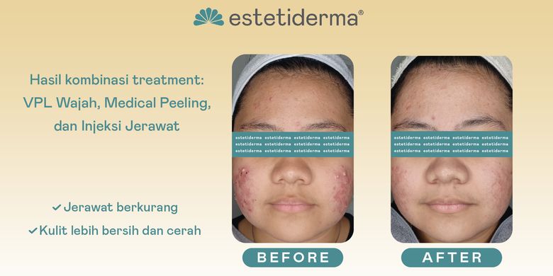 Beberapa perawatan yang bisa mengatasi jerawat, antara lain pengelupasan kulit medis (chemical peeling) Medical Peeling, terapi cahaya Variable Pulsed Light (VPL), dan injeksi jerawat.