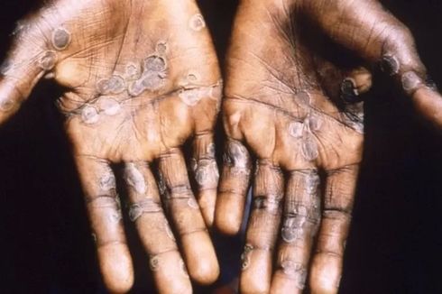 Monkeypox Bukan Disebabkan Vaksin atau Covid-19, Ini Kata Epidemiolog