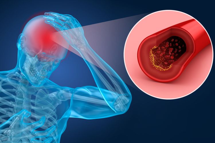 Stroke adalah penyakit otak yang disebabkan oleh adanya penumpukan plak (aterosklerosis) di arteri otak. 