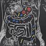 Infeksi E.coli di Usia Muda Tingkatkan Risiko Kanker Kolorektal