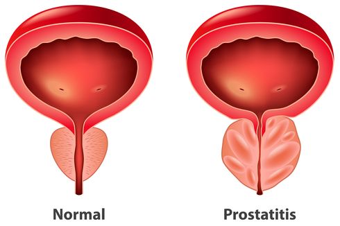 3 Penyebab Prostatitis, Biang Kelenjar Prostat Bengkak dan Radang