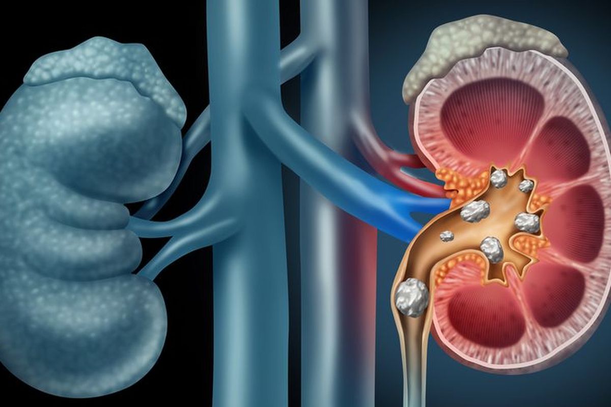 Ilustrasi batu ginjal. Batu ginjal pada pria lebih sering terjadi daripada wanita. Penyebab batu ginjal pada pria sering berasa dari pola makan tinggi protein dan garam.