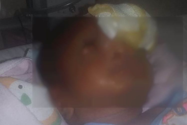 Bayi Haerul yang baru berusia 10 hari mengalami kelainan pada bagian alis dan kini tengah mendapat perawatan di RSUD Sawerigading, Kota Palopo, Sulawesi Selatan, Senin (28/12/2020)