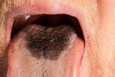 Hairy Tongue