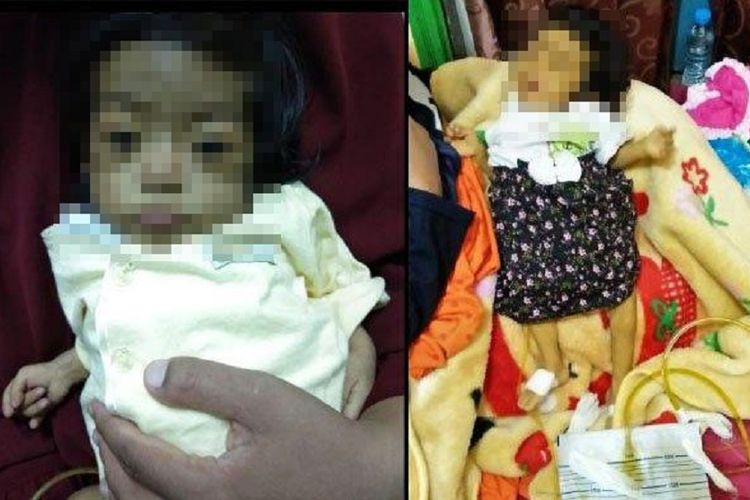 Fhatimah Bayi 8 Bulan Yang Divonis Serosis Hati Badan Menguning Tubuh Pakai Selang Urine Halaman All Kompas Com