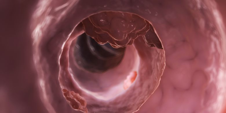4 Gejala Tumor Usus Besar yang Perlu Diwaspadai - Vimarsana News