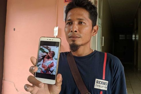 Bayi Kembar Siam Dempet Perut dan Dada Lahir di Medan