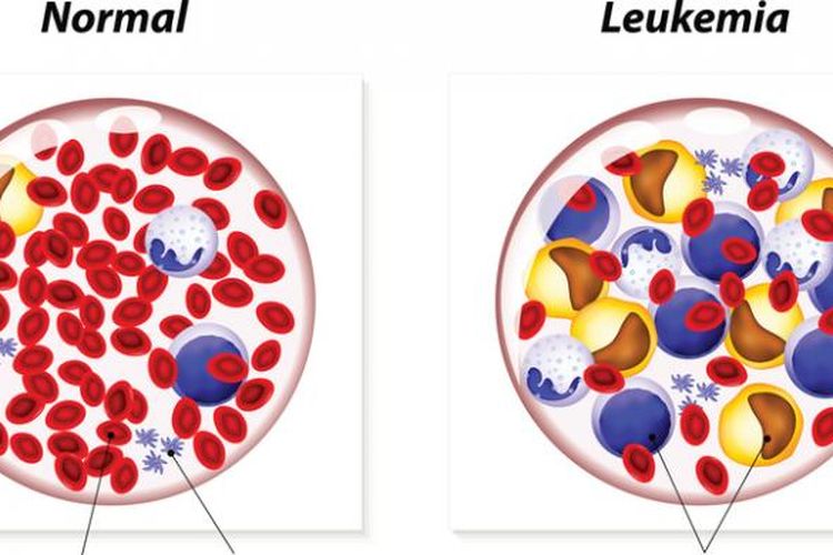Leukemia Adalah Penyakit Yang Disebabkan Oleh - Berbagai Sebab