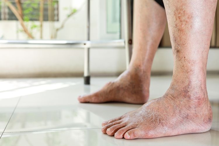 Ilustrasi penyakit gula kering atau gangrene kering