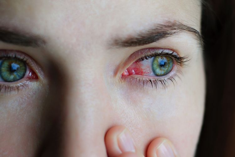 Salah satu penyebab mata merah adalah infeksi virus atau bakteri.