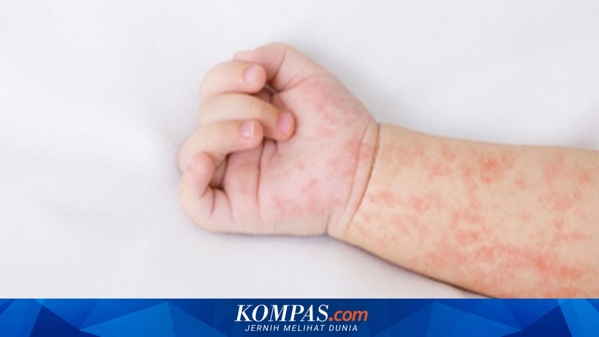 248 Kasus Suspek Campak Ditemukan di Bandung, Imunisasi Rendah Picu Risiko Penularan ~TR  

Klik untuk baca: