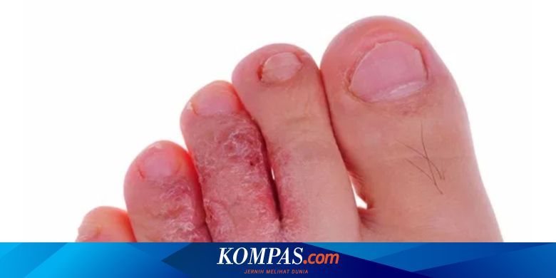 Penyebab Kutu Air, Gejala, Penularan, dan Cara Mencegahnya - Vimarsana News