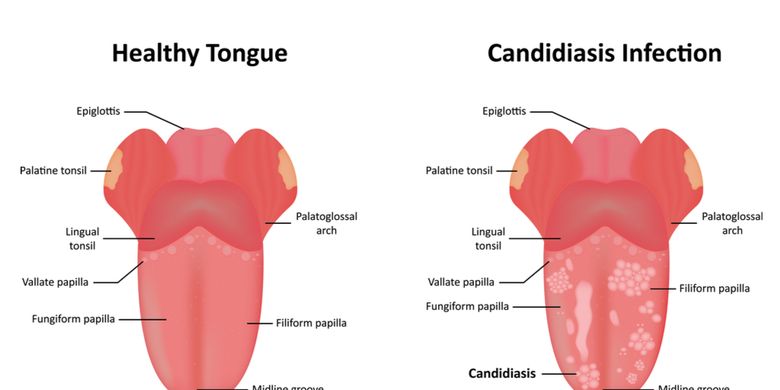 Penyakit Oral Thrush - Gejala, Penyebab, Pengobatan - Vimarsana News