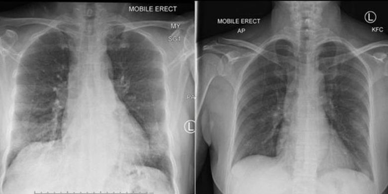 Hasil rontgen memperlihatkan paru-paru pasien bersih setelah sel-sel imun berperang melawan virus corona. Foto kiri pada hari kelima perawatan, foto kanan pada hari ke-10. 