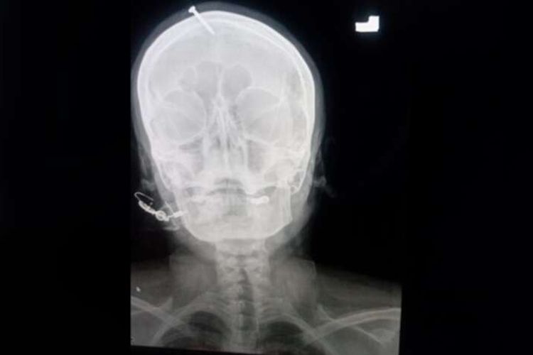 Hasil pemindaian x-ray yang memperlihatkan paku menancap di tengkorak seorang ibu hamil di Peshawar, Pakistan, yang mengikuti saran dukun agar memiliki anak laki-laki.