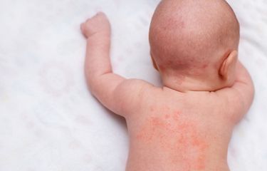 7 Cara Mengatasi Biang Keringat pada Bayi