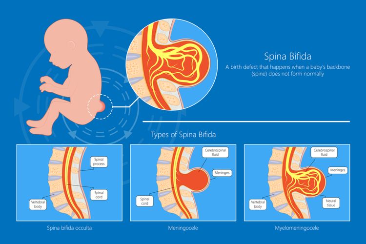 Ilustrasi spina bifida