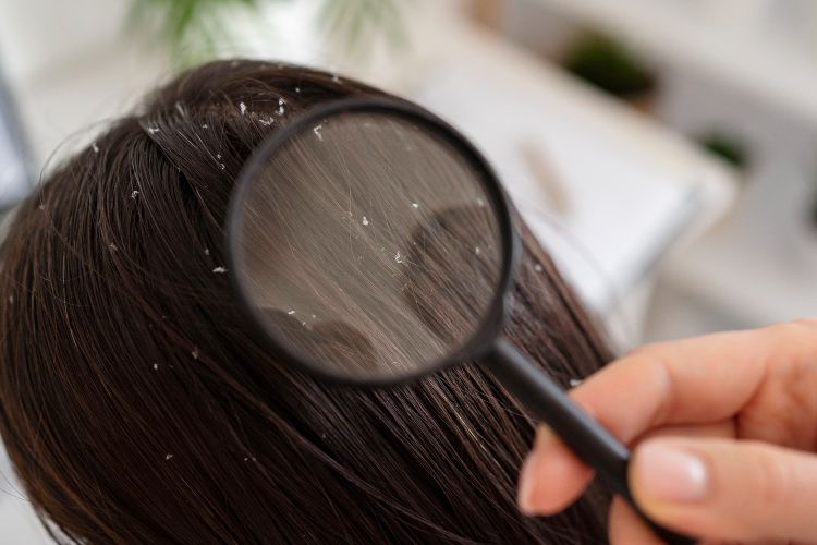 Mengatasi Rambut Berketombe dengan Menyehatkan Kulit Kepala