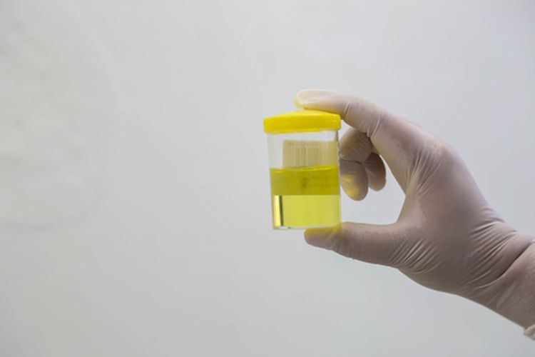 Ilustrasi urine normal, jumlah urine normal, produksi urine normal berapa banyak per hari. 