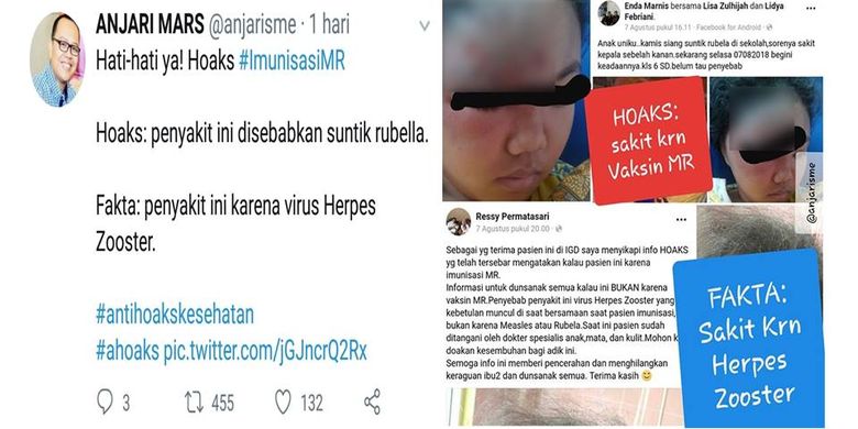 Anak LL (13) didiagnosa sakit Herpes Zooster, bukan karena imunisasi Measles Rubella.