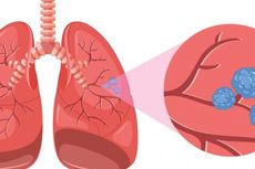 Selain Rokok, Ini Faktor Risiko Pemicu Kanker Paru