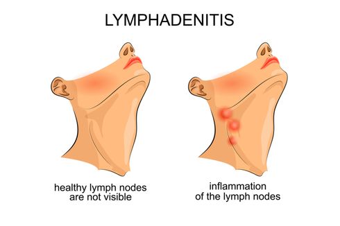 Limfadenitis