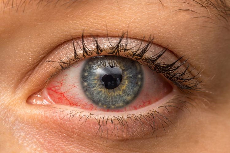 Cara mengobati mata merah dan berair adalah dengan beristirahat dan meneteskan obat tetes mata.