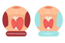 6 Penyakit Kelenjar Tiroid yang Paling Umum