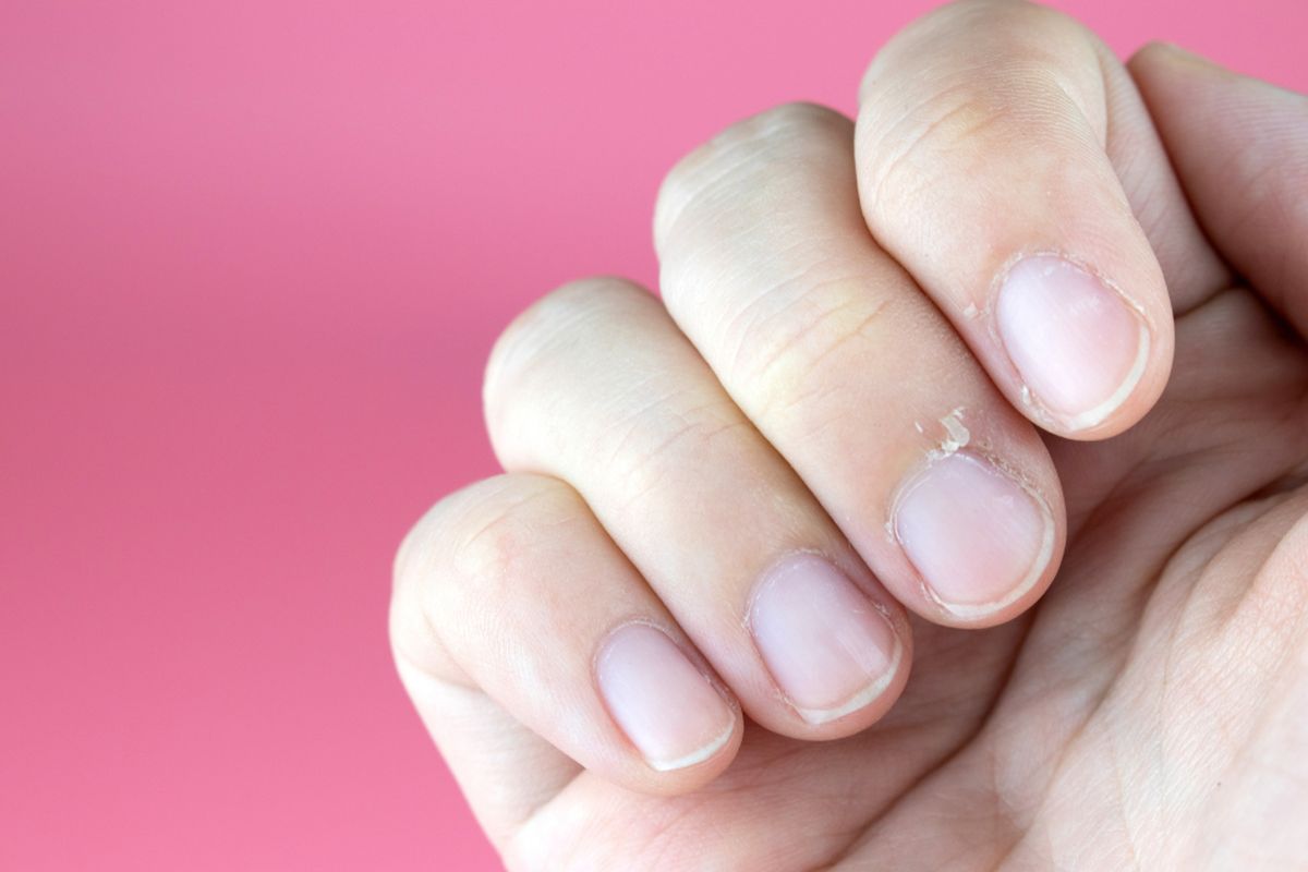 Ilustrasi bintil kuku (hangnails), gangguan kesehatan kuku jari yang banyak dialami. Salah penanganan dapat menyebabkan infeksi.