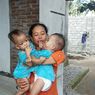 Kisah Bayi Kembar Siam di Lombok Timur, Punya 1 Hati, Butuh Biaya Operasi Rp 1 Miliar Lebih
