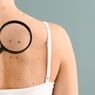 Nevus 
