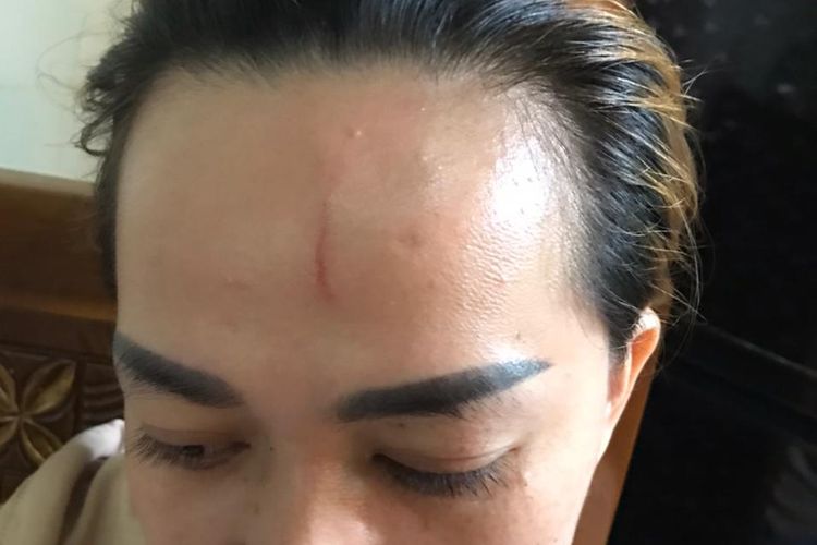 Kasus penganiayaan di Kabupaten Purworejo: Korban mengalami luka-luka dibagian jidat setelah penganiayaan yang dilakukan seorang pria. 