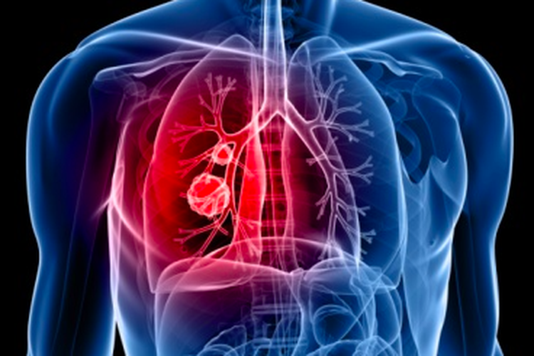 Ilustrasi kanker paru, ilustrasi kanker paru-paru stadium 4, cara mendiagnosis kanker paru-paru stadium 4
