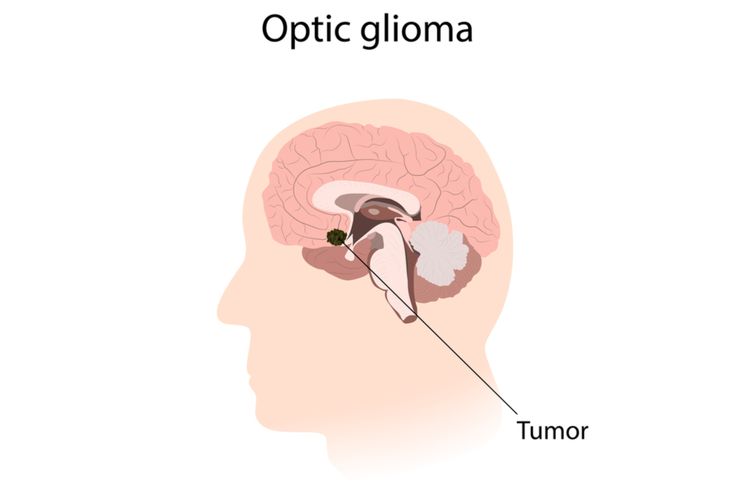 Ilustrasi optik glioma