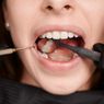 Karang Gigi Lepas Sendiri, Baik atau Justru Berbahaya?