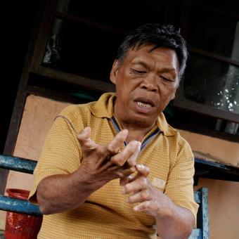 Felix (65), Orang yang Pernah Mengalami Kusta saat ditemui di Lembah Anugerah Hayat di Kelurahan Pandu, Kecamatan Bunaken, Manado.